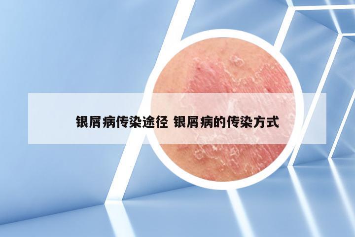 银屑病传染途径 银屑病的传染方式