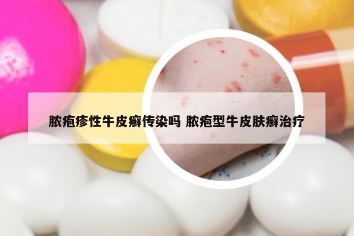 脓疱疹性牛皮癣传染吗 脓疱型牛皮肤癣治疗