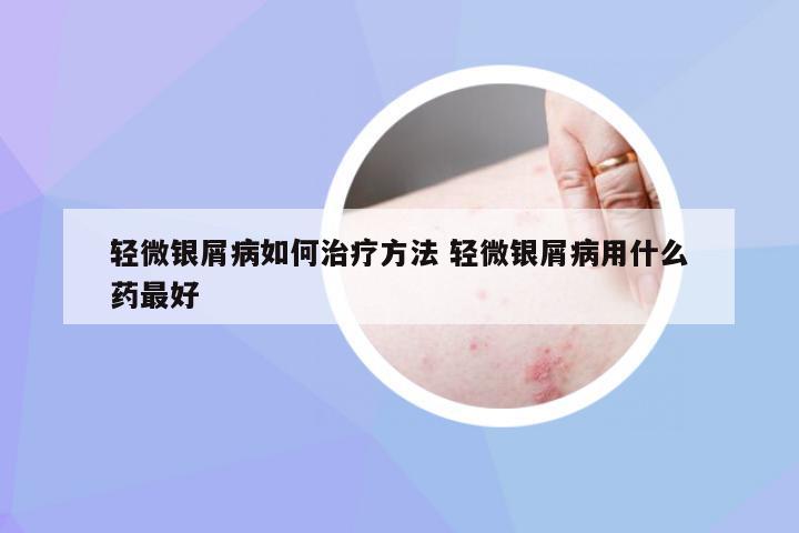 轻微银屑病如何治疗方法 轻微银屑病用什么药最好