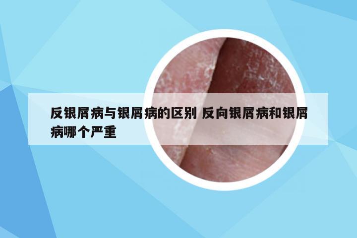 反银屑病与银屑病的区别 反向银屑病和银屑病哪个严重