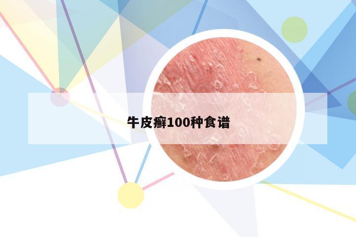 牛皮癣100种食谱