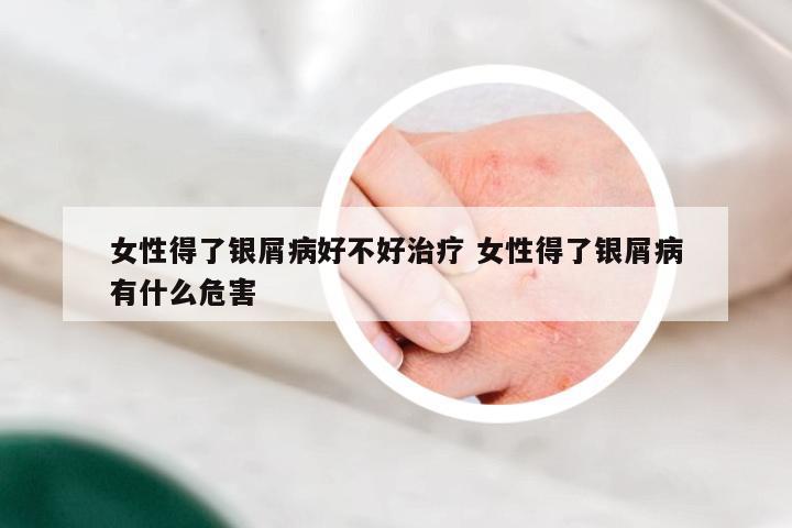 女性得了银屑病好不好治疗 女性得了银屑病有什么危害