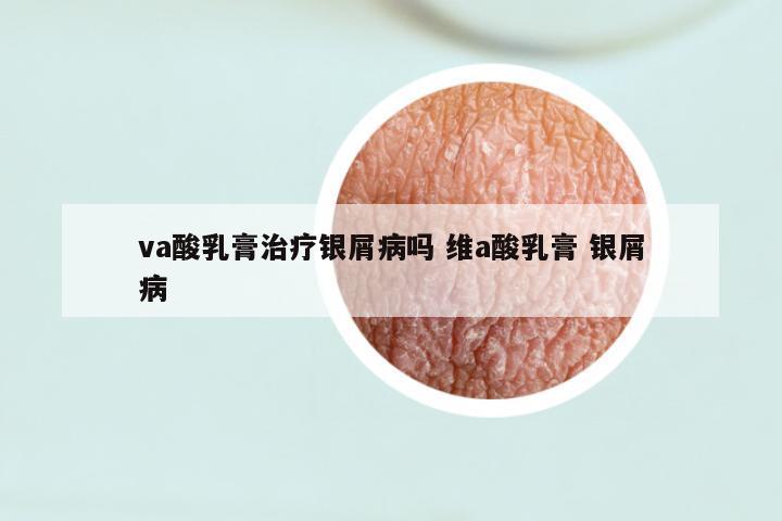 va酸乳膏治疗银屑病吗 维a酸乳膏 银屑病