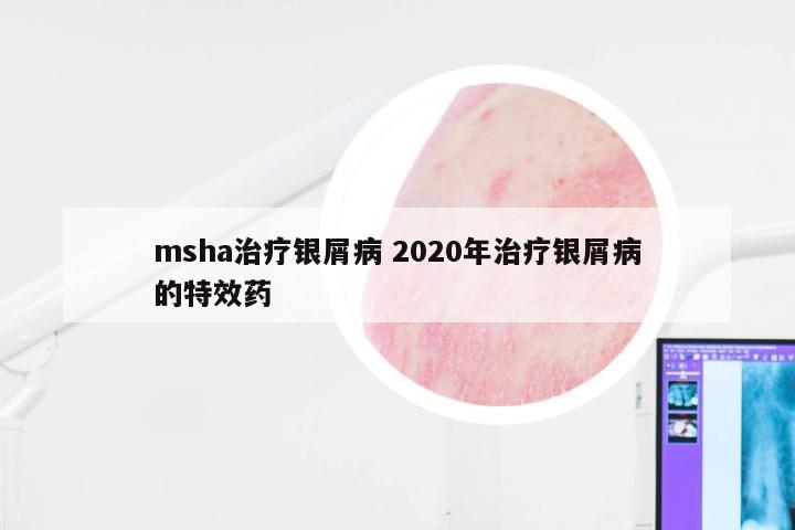 msha治疗银屑病 2020年治疗银屑病的特效药