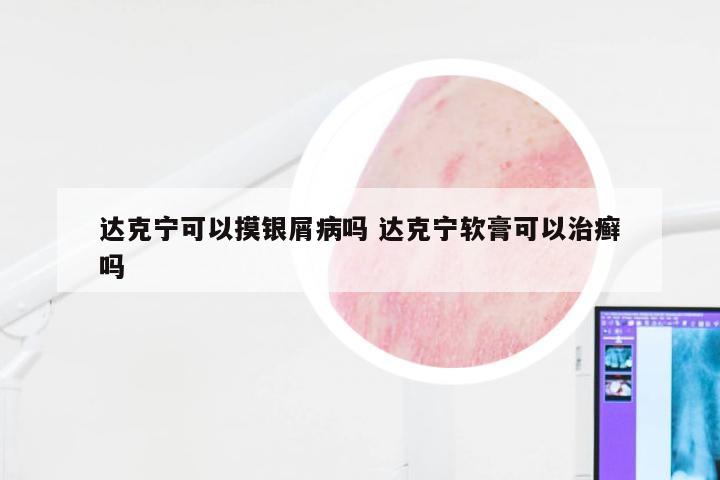 达克宁可以摸银屑病吗 达克宁软膏可以治癣吗