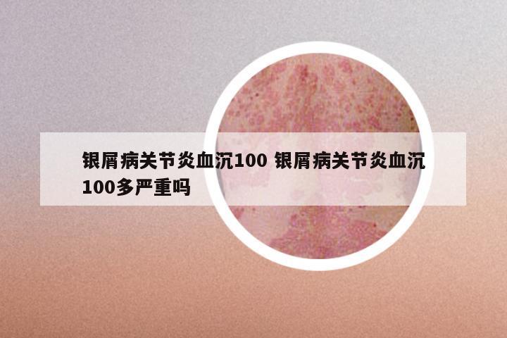 银屑病关节炎血沉100 银屑病关节炎血沉100多严重吗