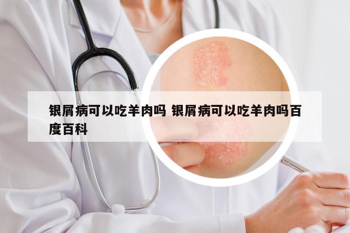 银屑病可以吃羊肉吗 银屑病可以吃羊肉吗百度百科