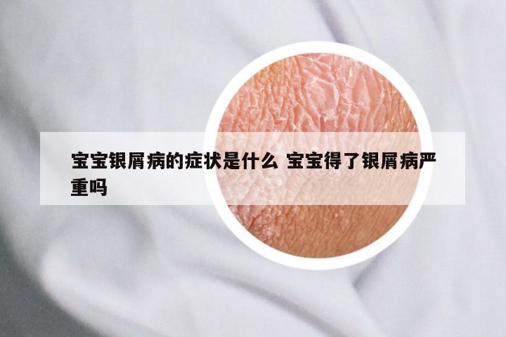 宝宝银屑病的症状是什么 宝宝得了银屑病严重吗