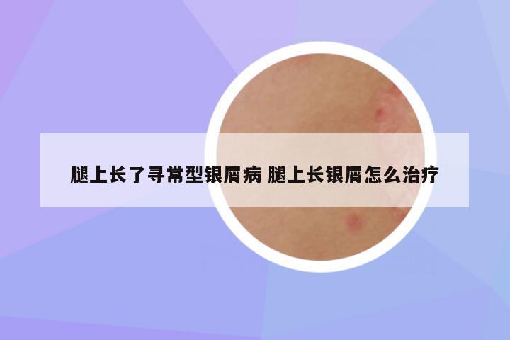 腿上长了寻常型银屑病 腿上长银屑怎么治疗