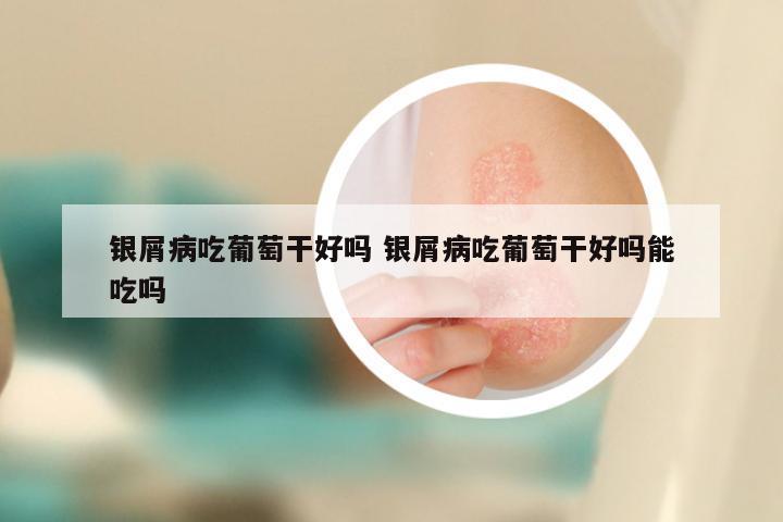 银屑病吃葡萄干好吗 银屑病吃葡萄干好吗能吃吗