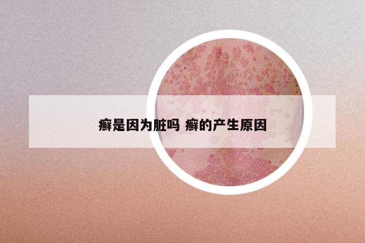 癣是因为脏吗 癣的产生原因