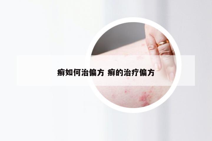 癣如何治偏方 癣的治疗偏方