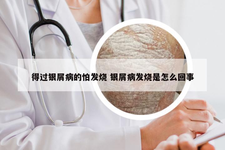 得过银屑病的怕发烧 银屑病发烧是怎么回事