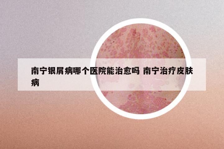 南宁银屑病哪个医院能治愈吗 南宁治疗皮肤病