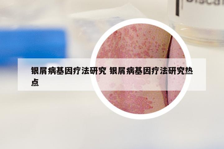 银屑病基因疗法研究 银屑病基因疗法研究热点