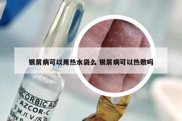 银屑病可以用热水袋么 银屑病可以热敷吗