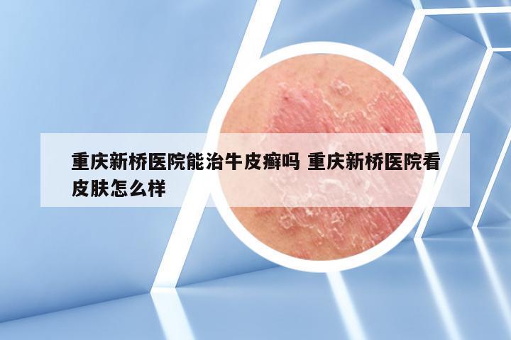 重庆新桥医院能治牛皮癣吗 重庆新桥医院看皮肤怎么样