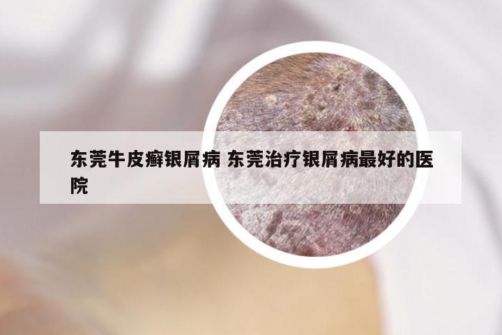 东莞牛皮癣银屑病 东莞治疗银屑病最好的医院