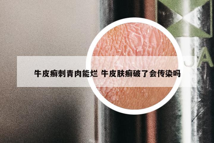 牛皮癣刺青肉能烂 牛皮肤癣破了会传染吗