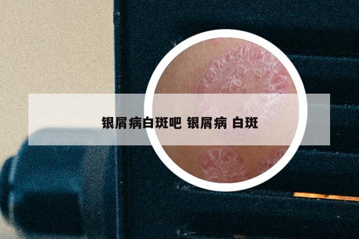 银屑病白斑吧 银屑病 白斑