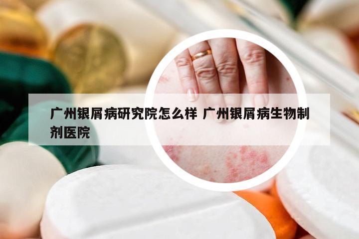 广州银屑病研究院怎么样 广州银屑病生物制剂医院