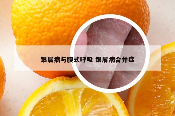 银屑病与腹式呼吸 银屑病合并症