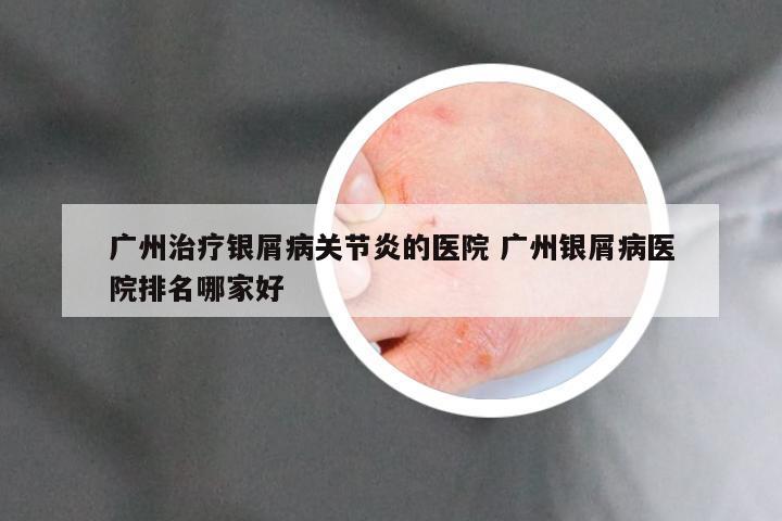 广州治疗银屑病关节炎的医院 广州银屑病医院排名哪家好