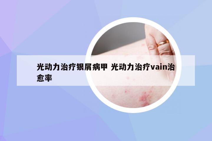 光动力治疗银屑病甲 光动力治疗vain治愈率