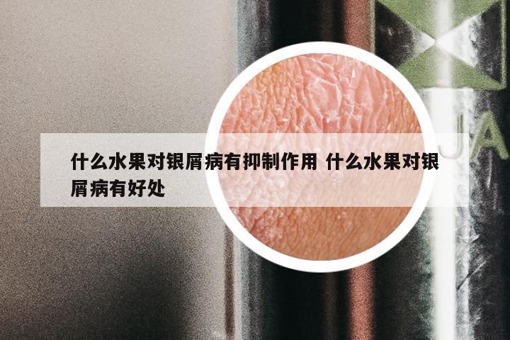 什么水果对银屑病有抑制作用 什么水果对银屑病有好处