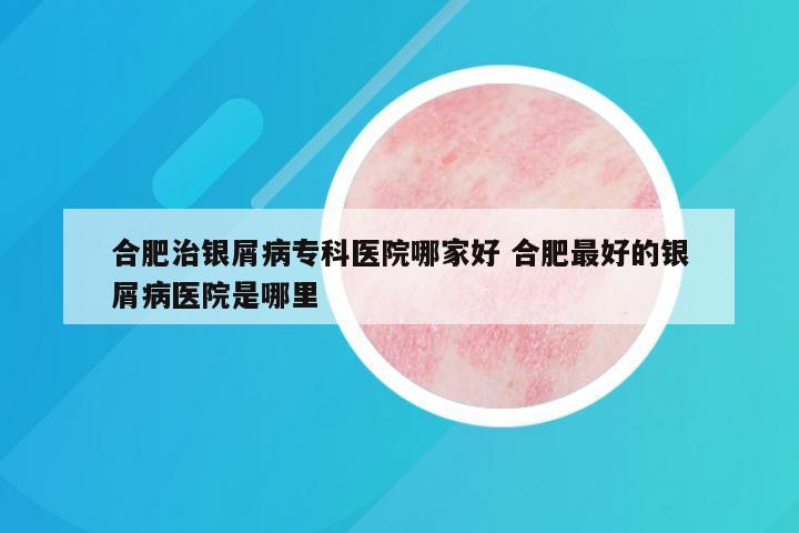 合肥治银屑病专科医院哪家好 合肥最好的银屑病医院是哪里