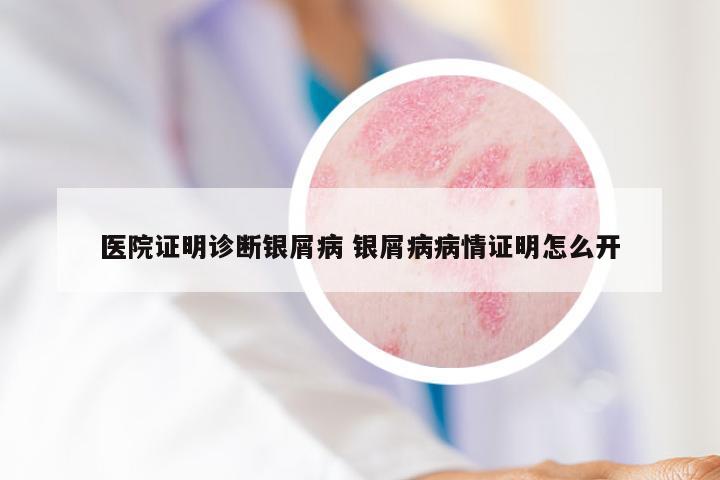 医院证明诊断银屑病 银屑病病情证明怎么开