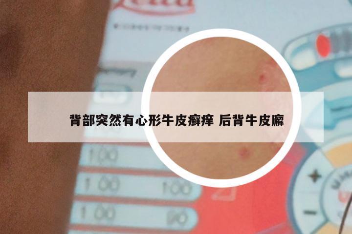 背部突然有心形牛皮癣痒 后背牛皮廨