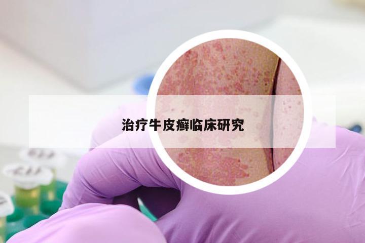 治疗牛皮癣临床研究