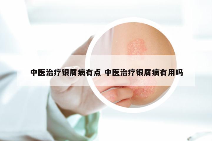 中医治疗银屑病有点 中医治疗银屑病有用吗