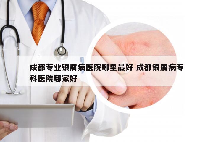 成都专业银屑病医院哪里最好 成都银屑病专科医院哪家好