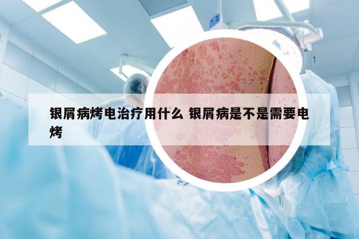 银屑病烤电治疗用什么 银屑病是不是需要电烤