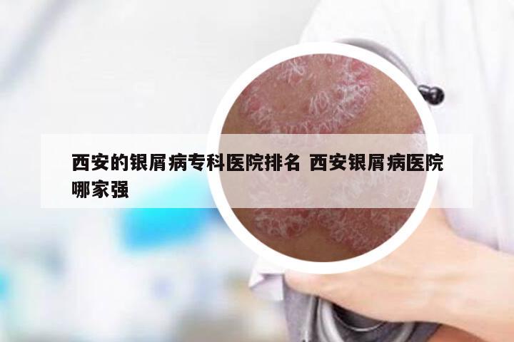 西安的银屑病专科医院排名 西安银屑病医院哪家强