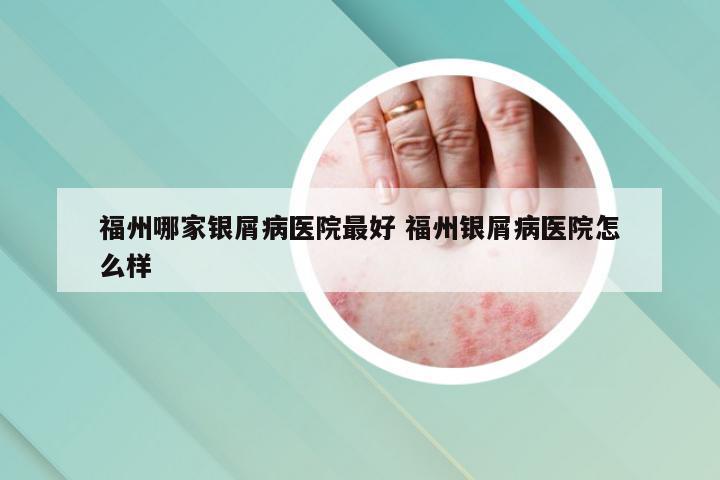 福州哪家银屑病医院最好 福州银屑病医院怎么样