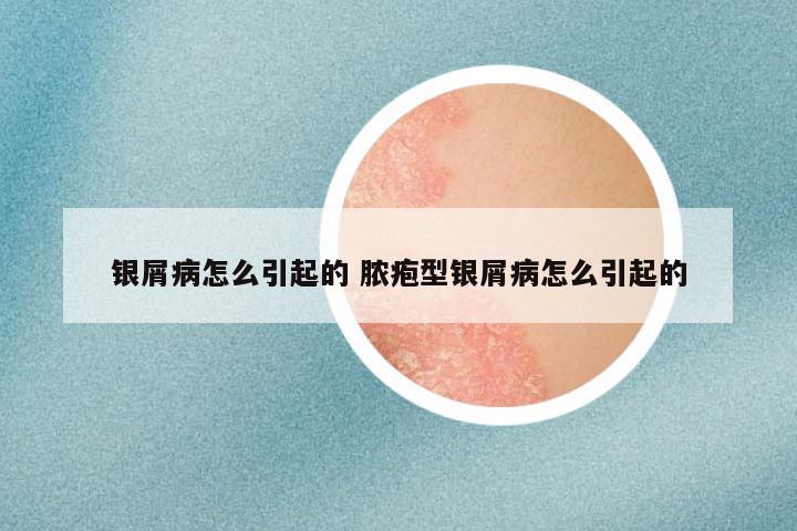 银屑病怎么引起的 脓疱型银屑病怎么引起的