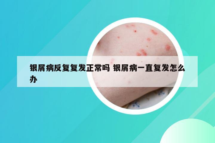 银屑病反复复发正常吗 银屑病一直复发怎么办