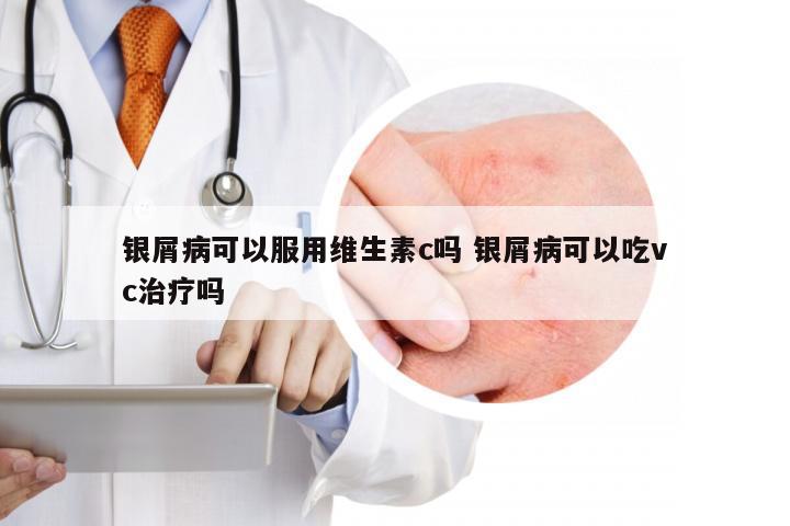 银屑病可以服用维生素c吗 银屑病可以吃vc治疗吗