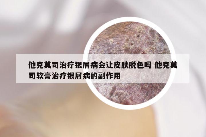 他克莫司治疗银屑病会让皮肤脱色吗 他克莫司软膏治疗银屑病的副作用