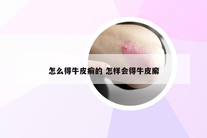 怎么得牛皮癣的 怎样会得牛皮廨