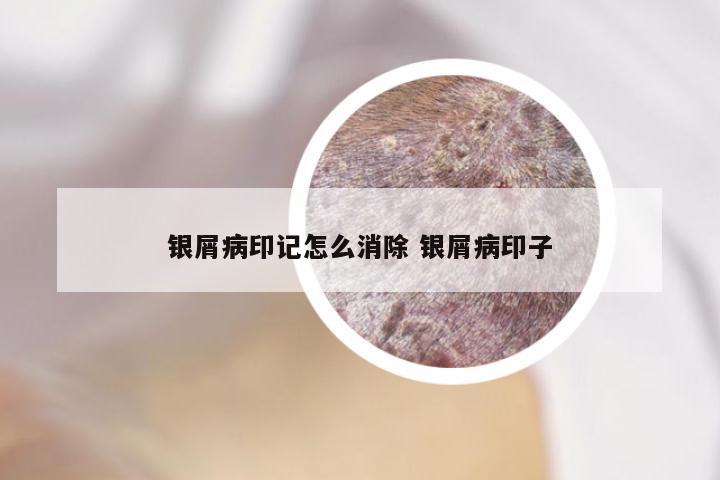 银屑病印记怎么消除 银屑病印子