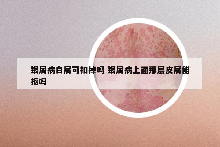 银屑病白屑可扣掉吗 银屑病上面那层皮屑能抠吗