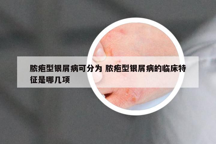 脓疱型银屑病可分为 脓疱型银屑病的临床特征是哪几项