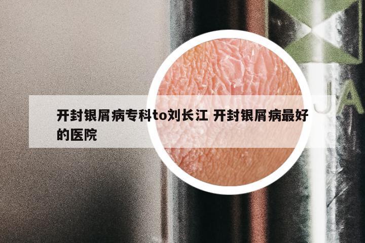 开封银屑病专科to刘长江 开封银屑病最好的医院