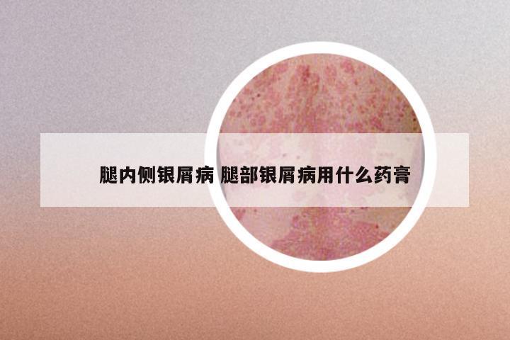 腿内侧银屑病 腿部银屑病用什么药膏