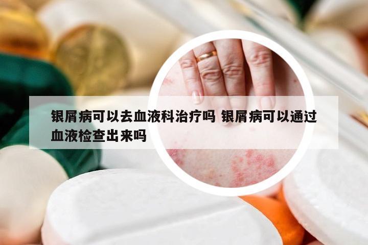 银屑病可以去血液科治疗吗 银屑病可以通过血液检查出来吗