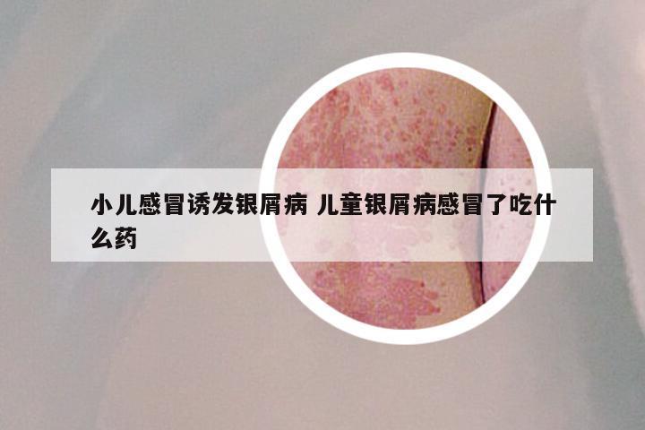 小儿感冒诱发银屑病 儿童银屑病感冒了吃什么药